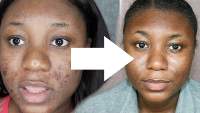 Chemical Peel Results After a Glycolic and Salicylic peel